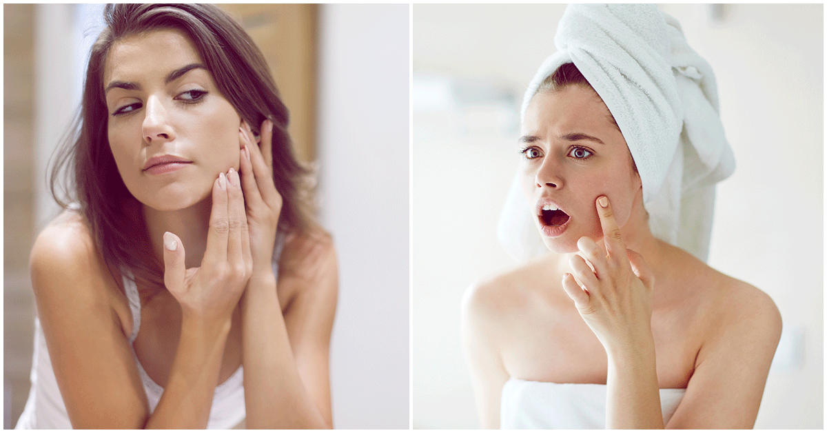 Los mejores tratamientos para las chicas con acné