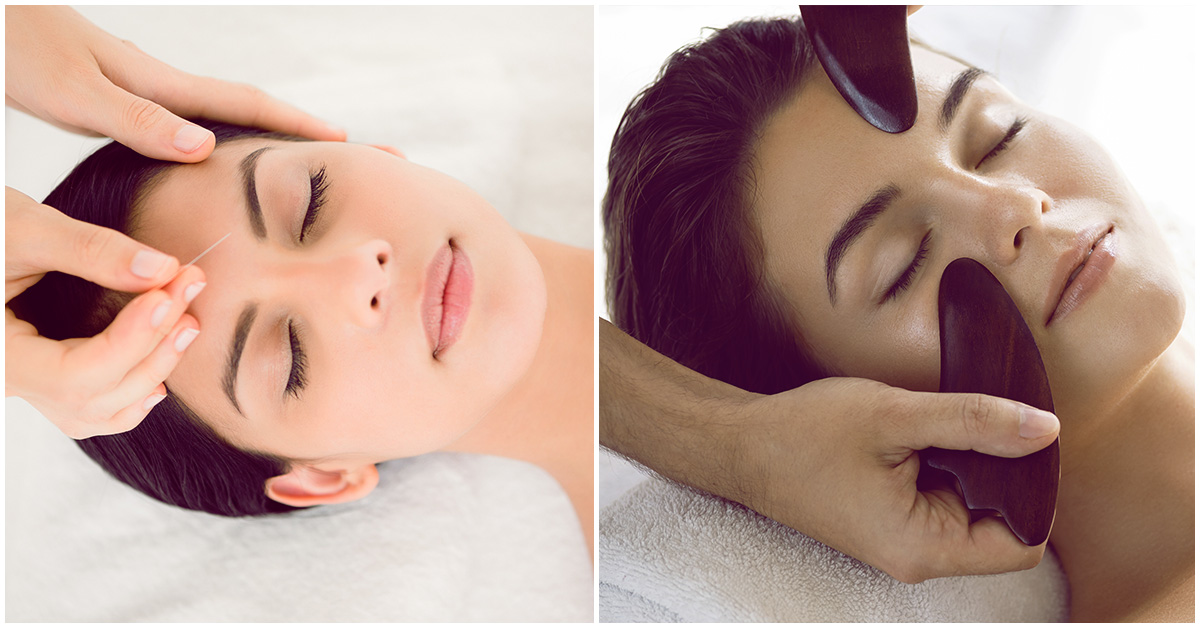 Acupuntura facial, todo lo que tienes que saber