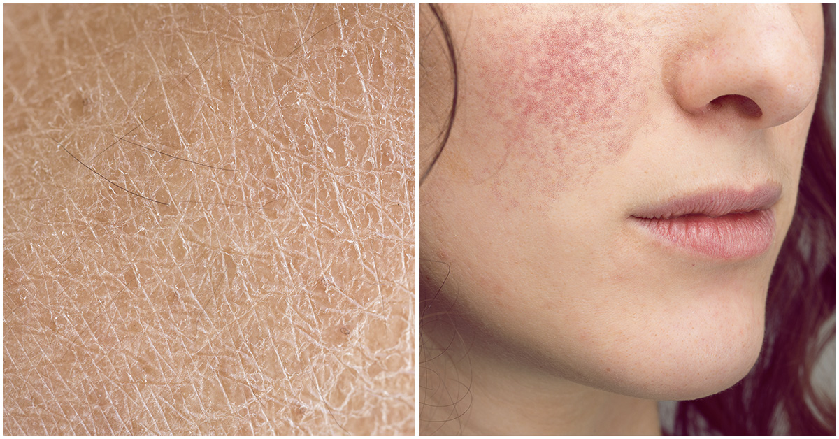 5 ingredientes que son enemigos de la piel seca