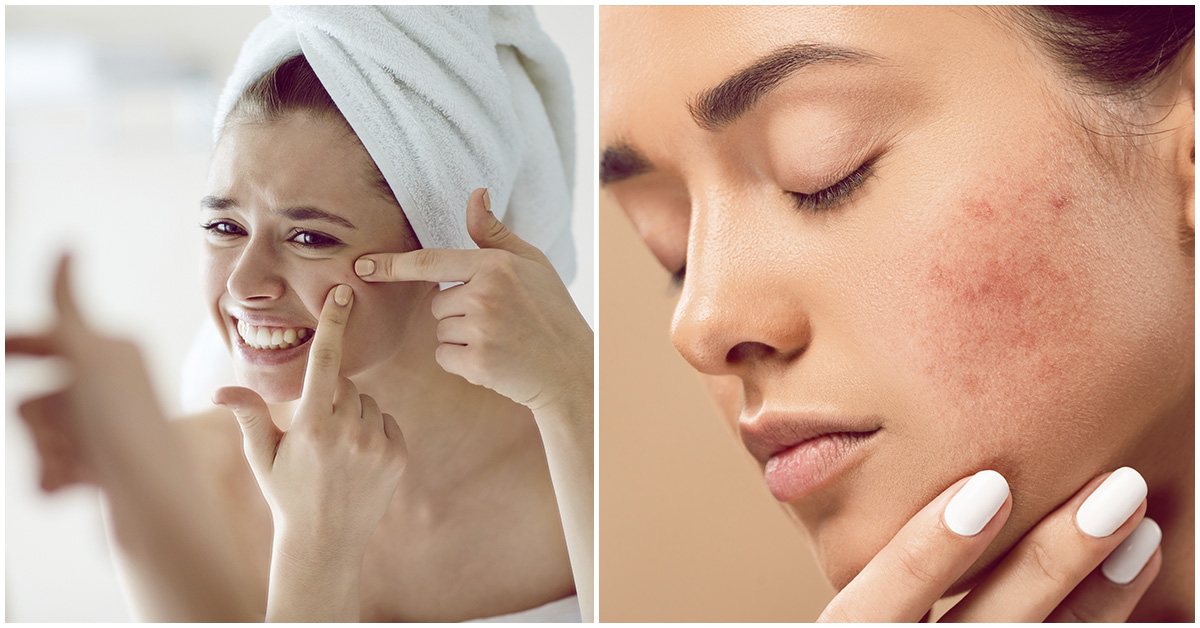 Hábitos que están empeorando tu acné ¡No lo hagas!